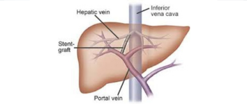 Stroke Treatment